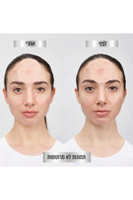 מדבקות פצעונים PURE ACTIVE