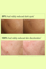 סרום להבהרה ותיקון כתמים כהים בעור